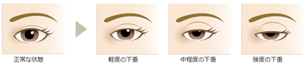 眼瞼下垂の重症度
